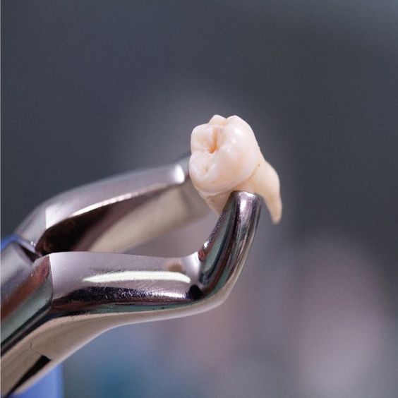 Dental tooth extractions